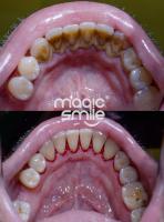 Dentální hygiena, Odstranění zubního kamene a plaku Air-Flow