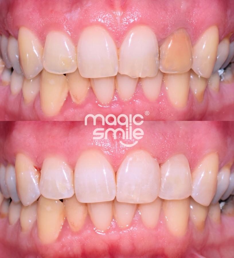 Vnitřní bělení zbarveného zubu a dostavba uštípnutí u předního zubu 