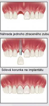 Implantace zubu