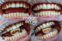 Dentální hygiena - Odstranění zubního kamene a plaku Air-Flow