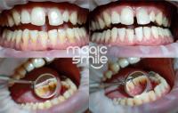 Dentální hygiena - Odstranění zubního kamene a plaku Air-Flow