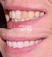 Vnitřní bělení zbarveného zubu, odstraněn mezizubní kaz, dostavba uštípnutí u předního zubu 