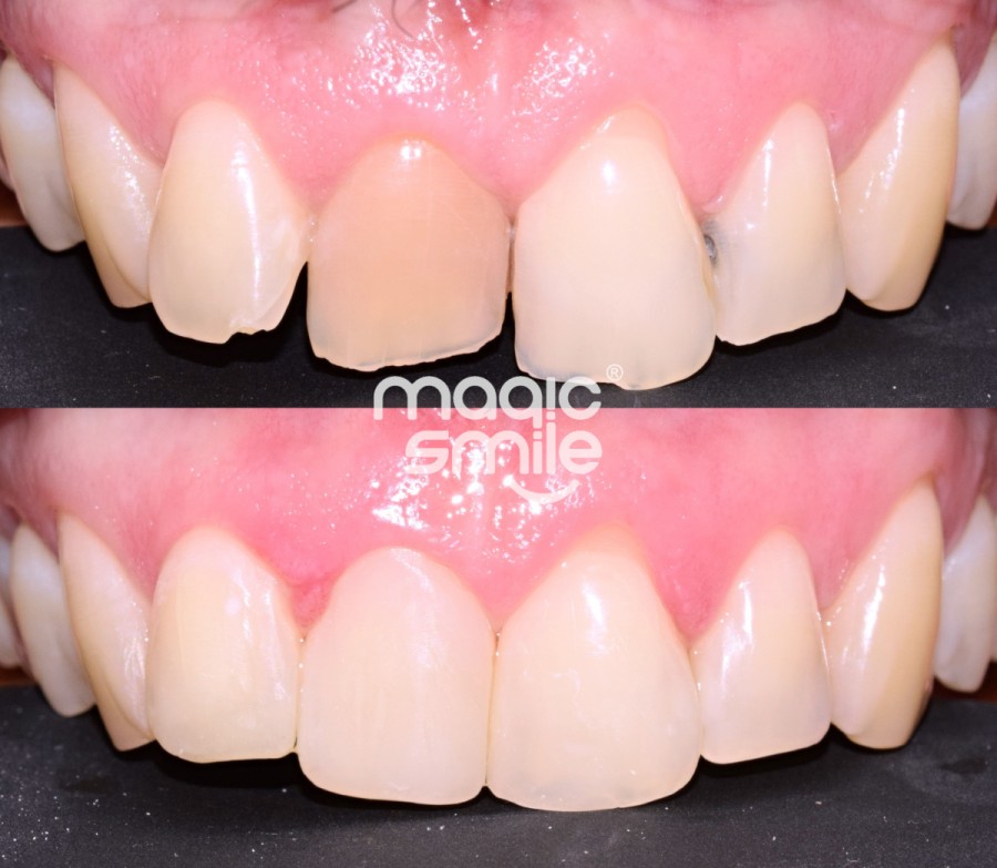 Odstraněn mezizubní kaz, vnitřní bělení zbarveného zubu, estetická dostavba u předních zubů