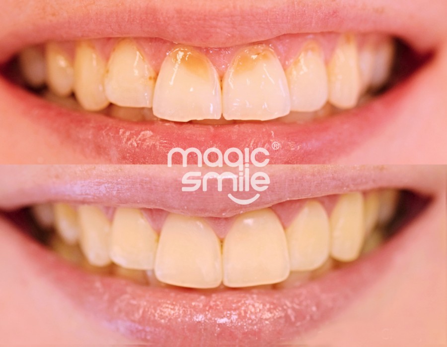 Estetická dostavba fotokompozitní bílou výplní u předních šesti zubů