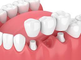 Zubní můstky