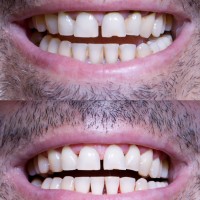 Dental hygiene and teeth whitening