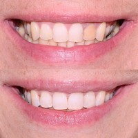 Эстетическая реставрация зубов